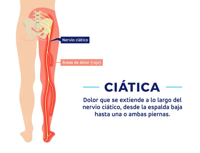 Geometría inversión Pence Qué pierna afecta el nervio ciático? - Haras Dadinco