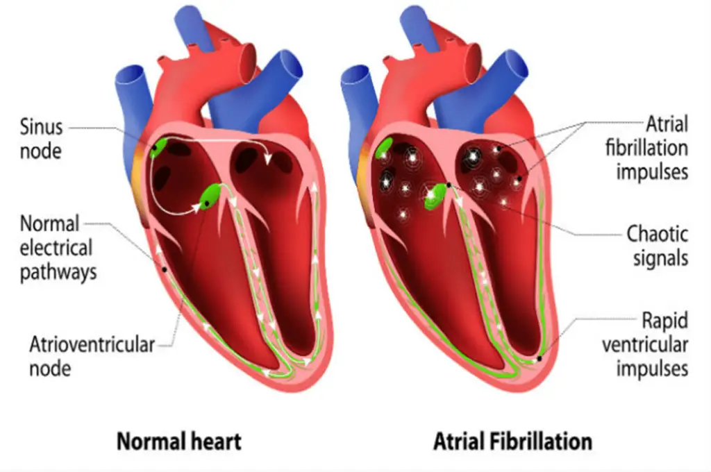 Qué Es La Arritmia En El Corazón Haras Dadinco Qué Es La Arritmia En El Corazón Haras Dadinco
